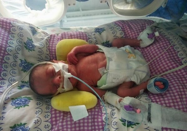 В Одессе медики спасли двух младенцев, которые весили менее 900 грамм 