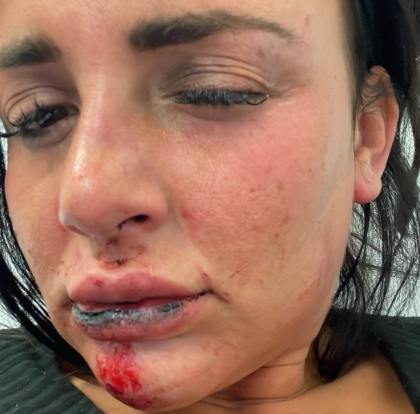 Футболіст жорстоко побив свою дівчину: щоб урятуватися, та вистрибнула з балкона (фото, відео)