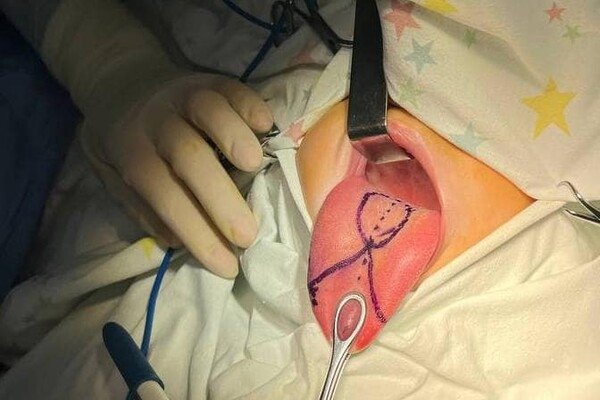 Малышу из Одесской области сделали уникальную операцию на язык: он был в пять раз длиннее