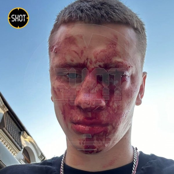 Чемпіону Європи з боксу вибили око у Криму (фото, відео)